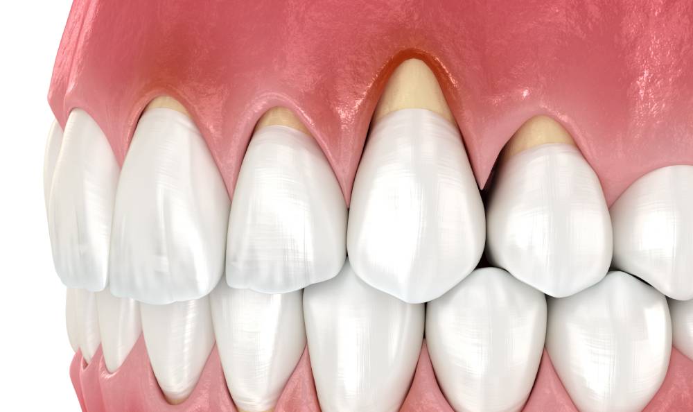 Kaip išsivysto periodonto ligos?